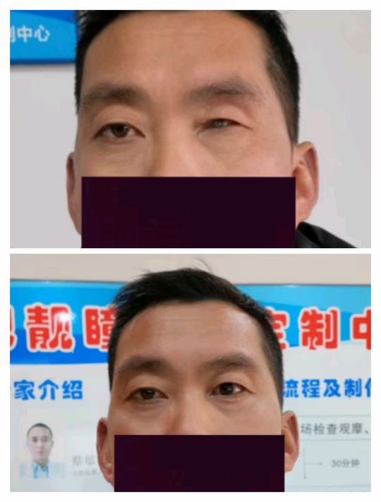 合肥靓瞳义眼定制中心